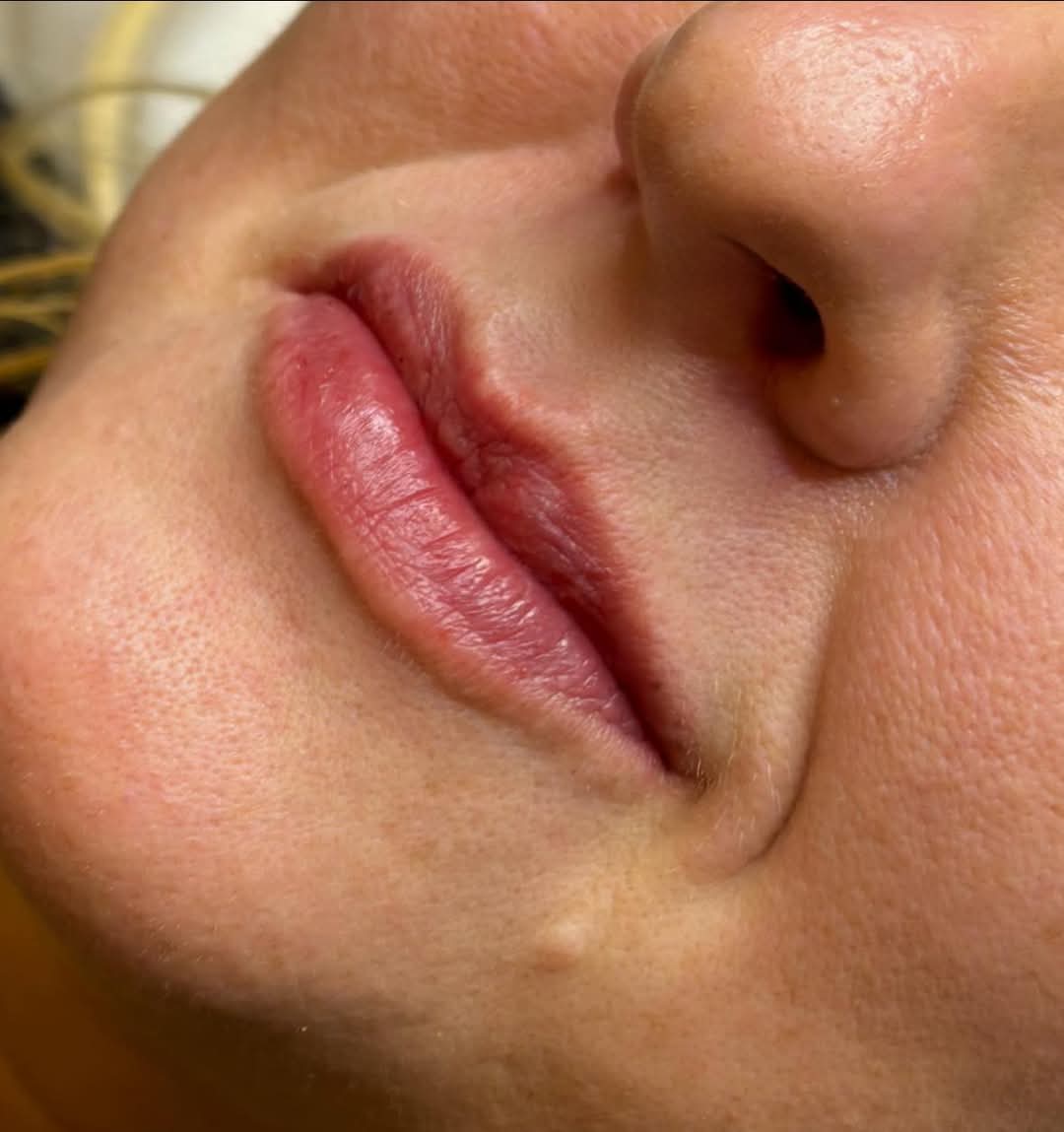 Treatment After
